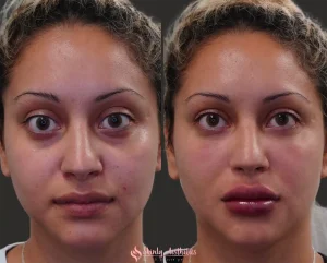 Full-face rejuvenation with Liquid Facelift: smoother skin, lifted features, younger appearance