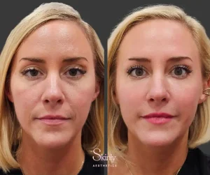 Liquid Facelift before and after results showing smoother skin and corrected under-eye hollows