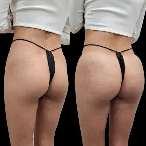 Side view showing lifted and fuller buttocks after dermal filler injections