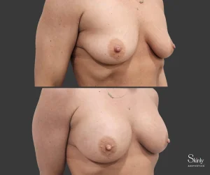 Non-surgical breast enhancement before and after results at a 45 degree angle