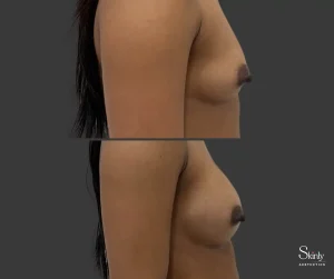 Side profile before-and-after non-surgical breast enhancement