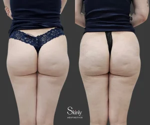 Dermal filler butt lift results from angled back view