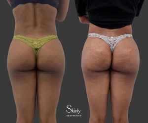 Sculptra-based liquid butt lift results from back-side view