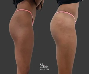 Non-surgical BBL results shown from side perspective