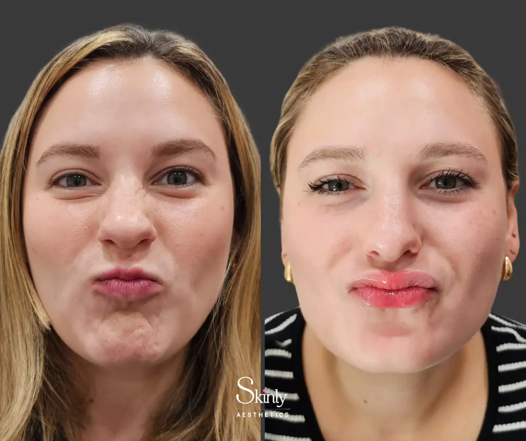 Female patient showing before and after results of Botox injected into the mentalis muscle to reduce chin dimpling, performed by Dr. Schwarzburg on Manhattan’s Upper East Side