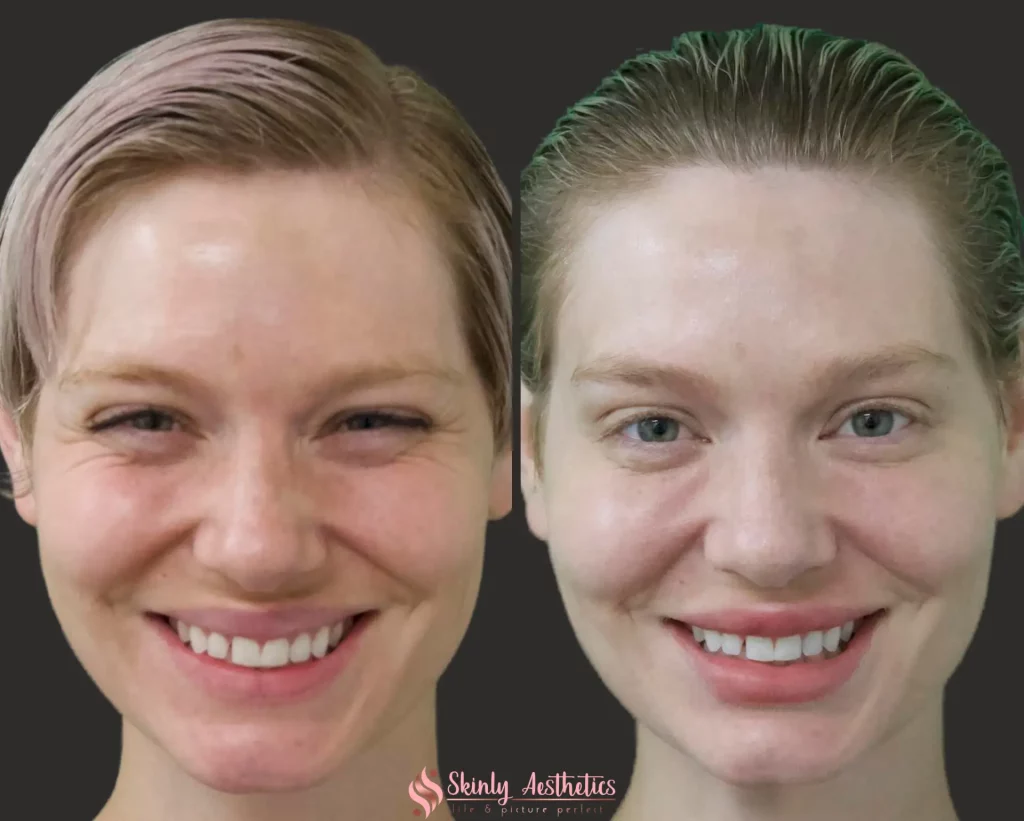 Female patient before and after Botox treatment showing softening of crow’s feet wrinkles around the outer eyes while smiling