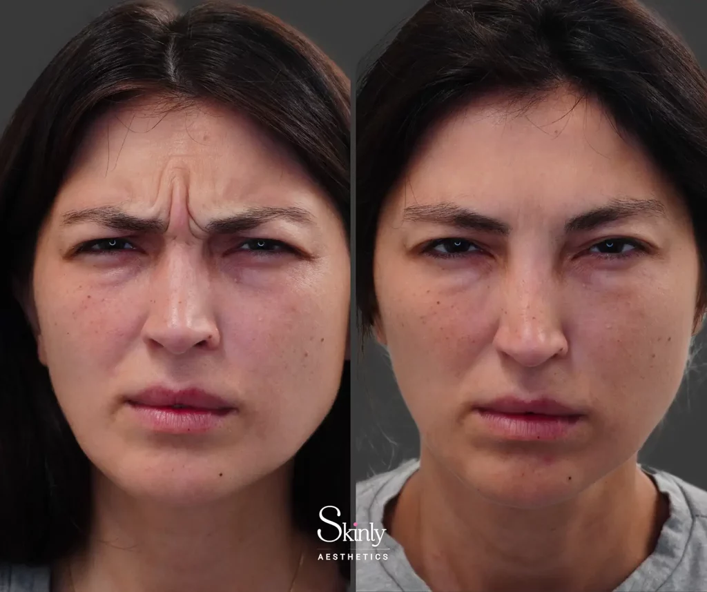 Before and after Botox treatment showing reduction of glabellar frown lines between the eyebrows in a female patient at Skinly Aesthetics in NYC