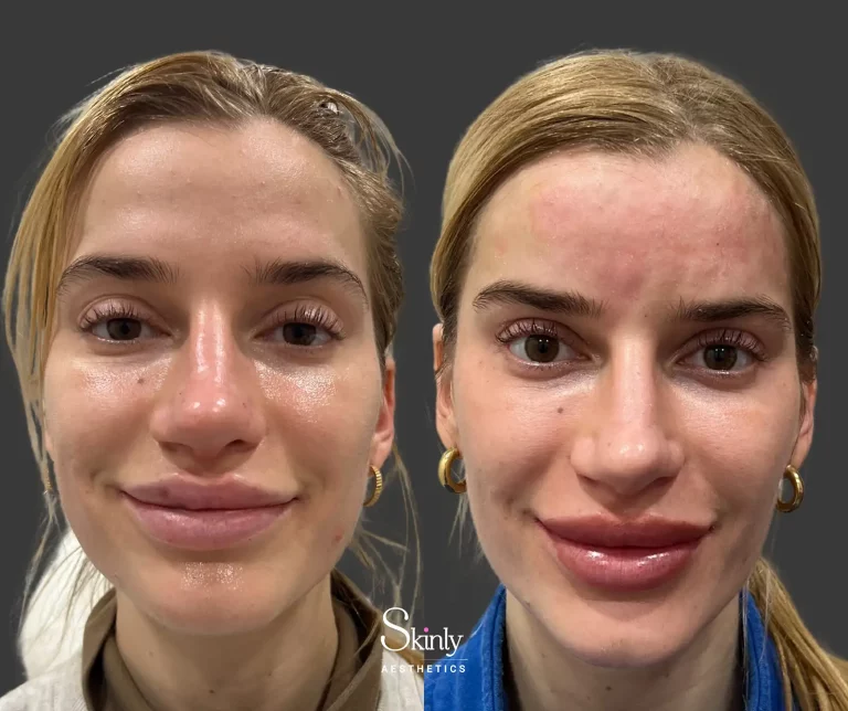 Front-facing photo showing forehead filler used to add projection and soften overall appearance.