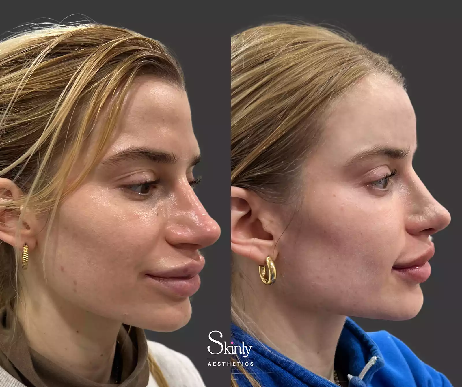 Forehead filler before and after showing restored volume and smoother contour in a female patient.