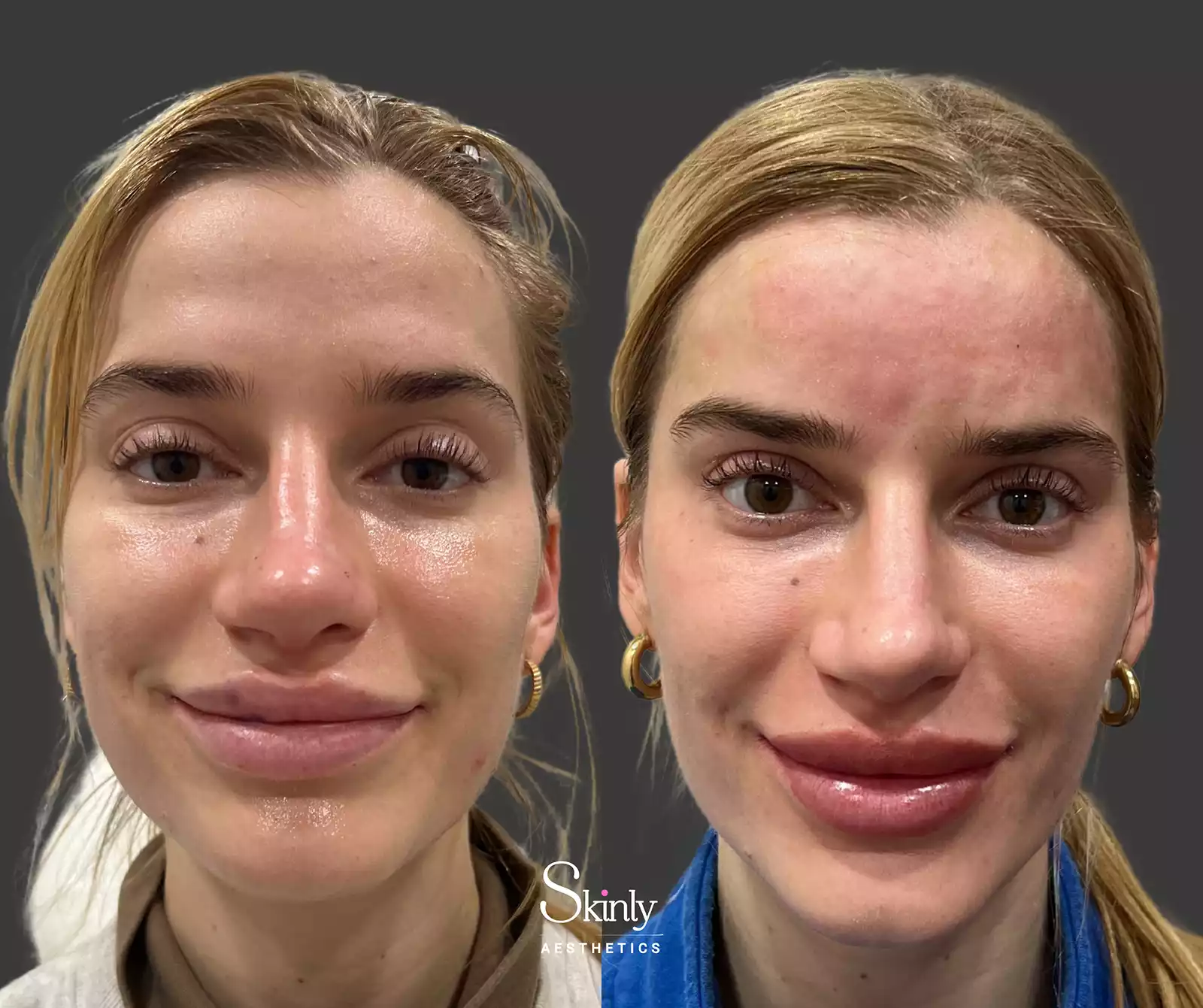 Close-up forehead filler result correcting indentation and achieving natural forehead curvature