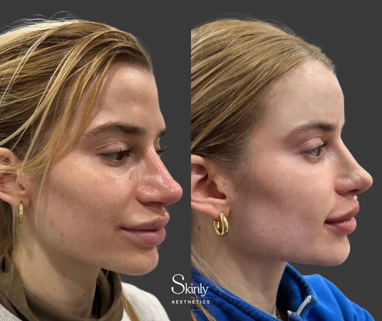 Side view of forehead filler correcting hollow contours and improving upper facial harmony.