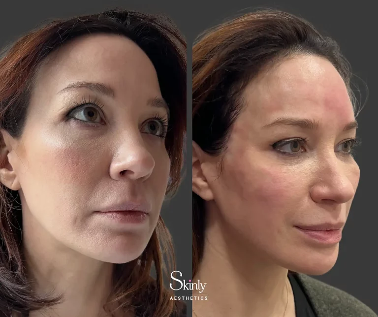 Forehead filler before and after showing improved curvature and smoother upper face contour
