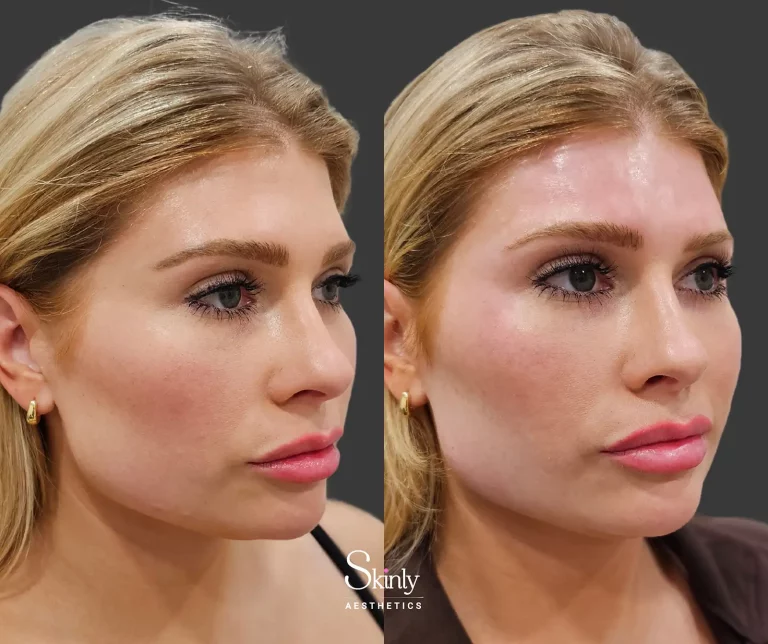 Side view before and after forehead filler correcting hollow areas for improved symmetry