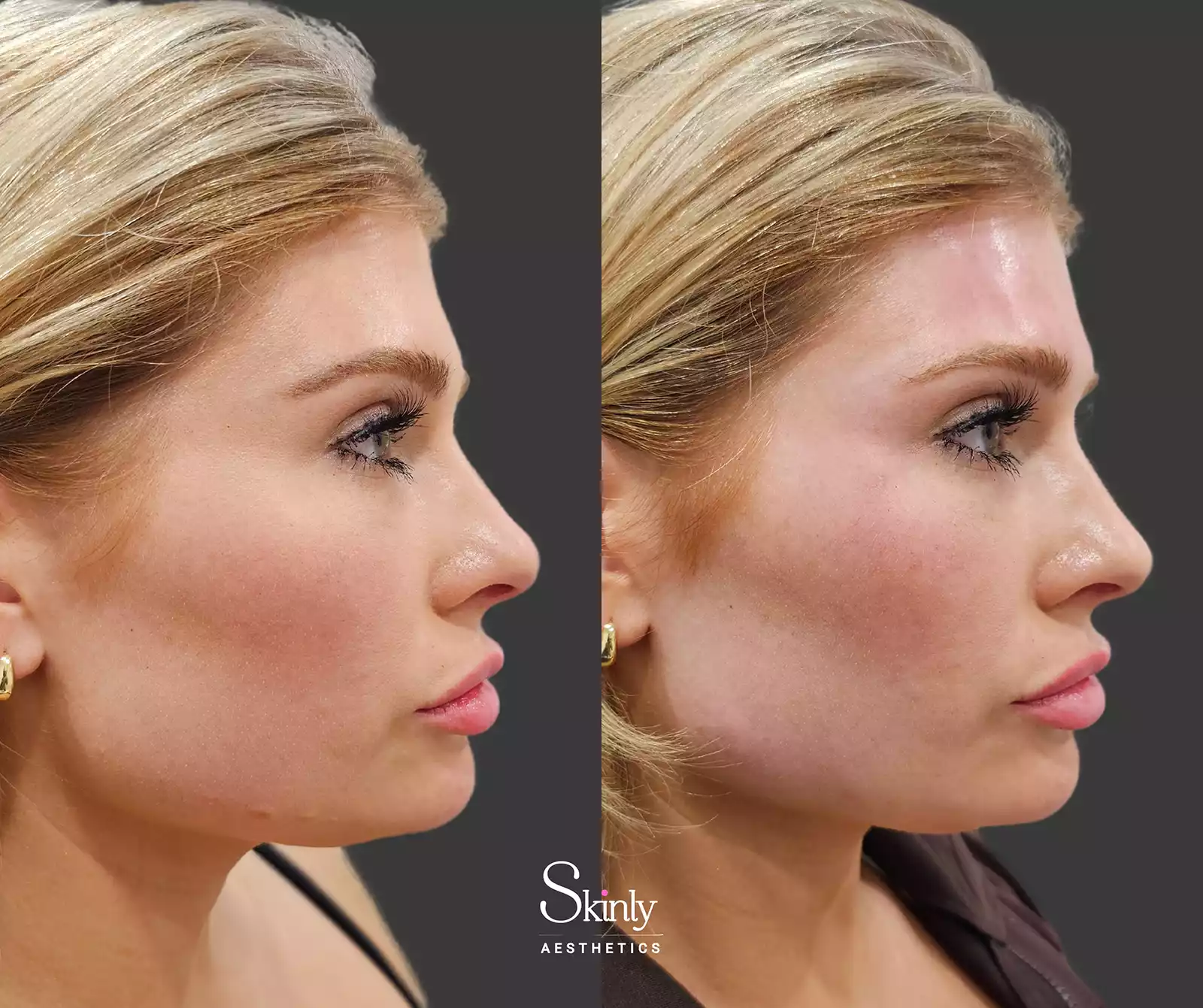 Patient results after forehead filler showing enhanced contour and smoother brow transition.