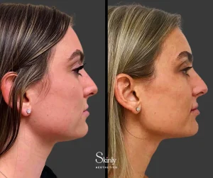 Before and after double chin treatment with Kybella, showing double chin reduction.