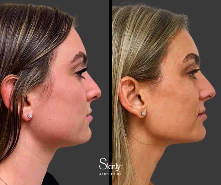 Before and after double chin treatment with Kybella, showing double chin reduction.