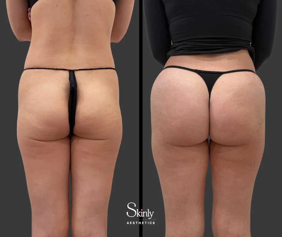 Non-surgical BBL demonstrating buttocks augmentation with dermal filler