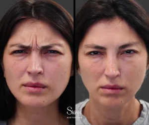 Before and after Botox for 11s glabellar frown lines between the eyebrows in NYC