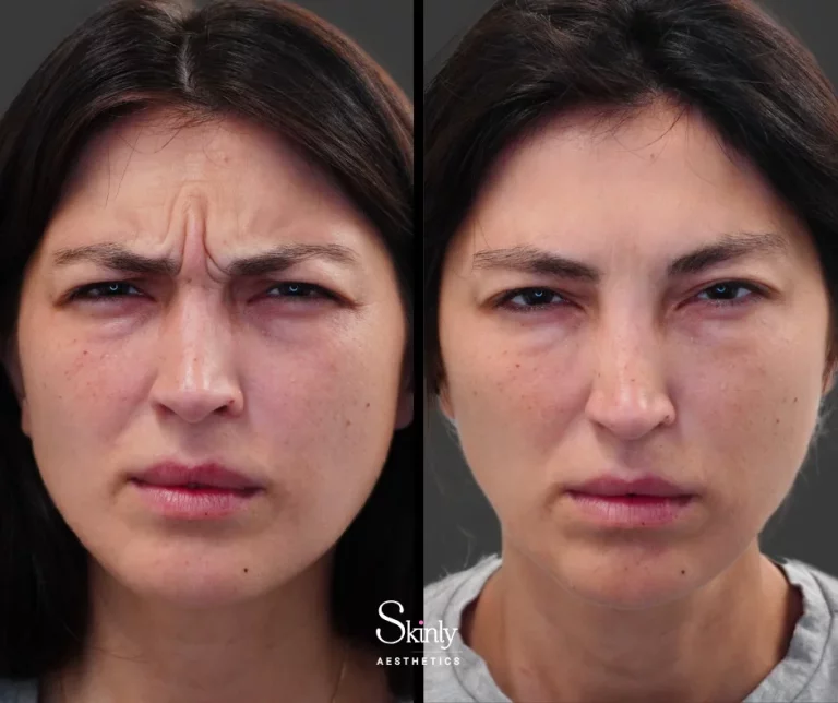Before and after Botox for 11s glabellar frown lines between the eyebrows in NYC