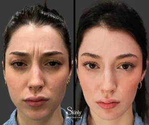 Before and after Botox for 11s, aka glabellar lines between the brows.