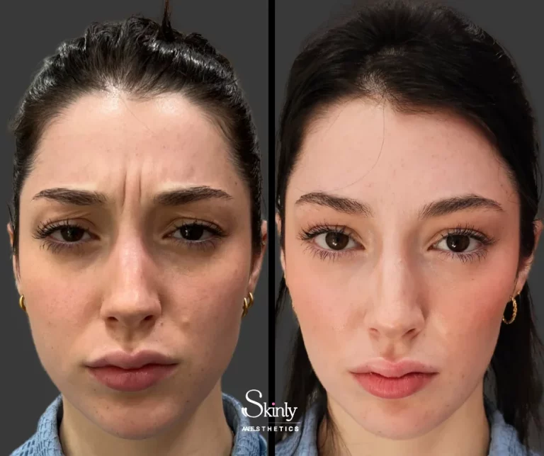 Before and after Botox for 11s, aka glabellar lines between the brows.
