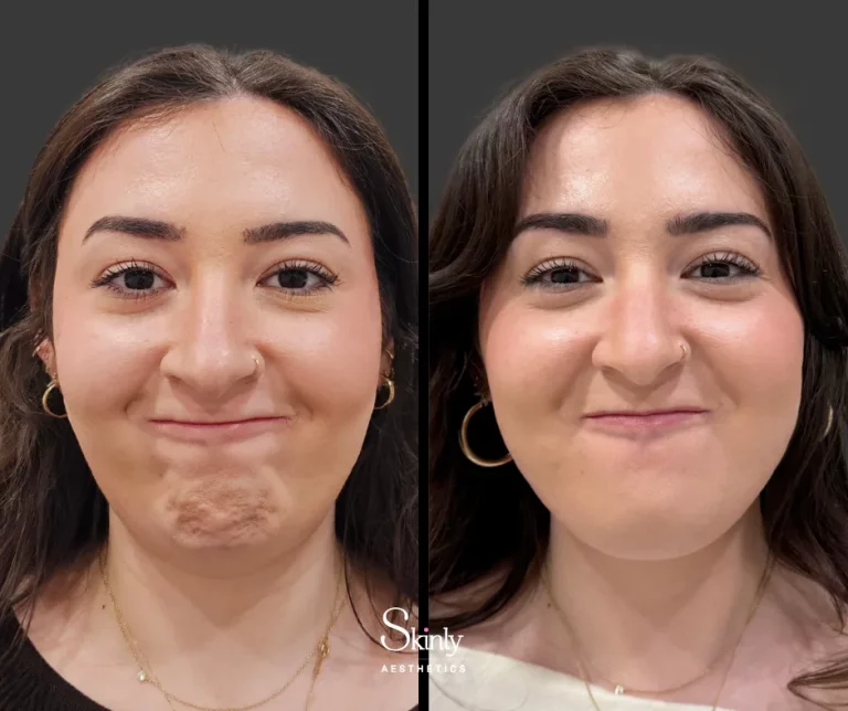 Before and after chin Botox for smoothing dimples and improving chin contour.