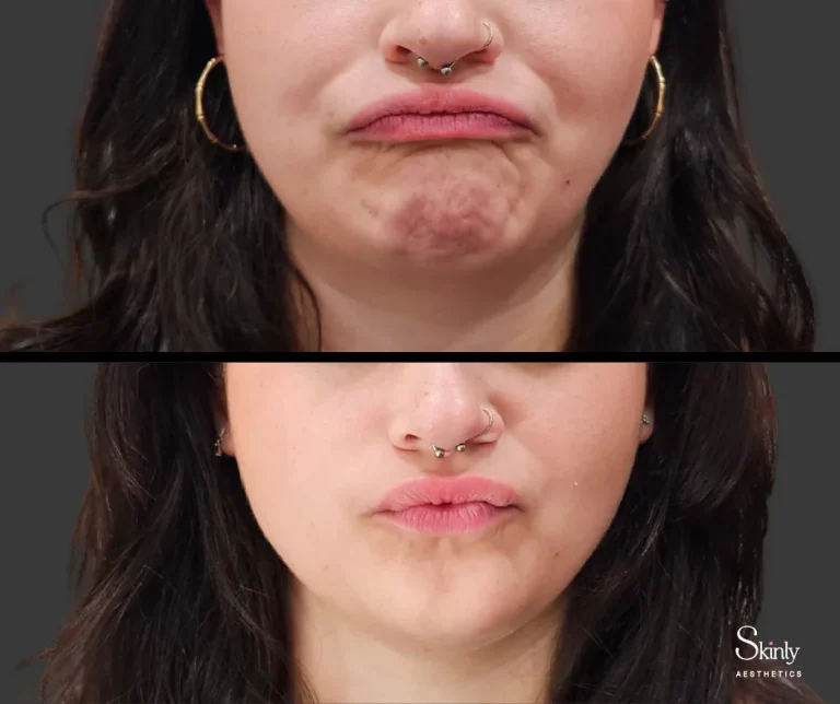 Before and after results chin Botox to smooth dimpling.