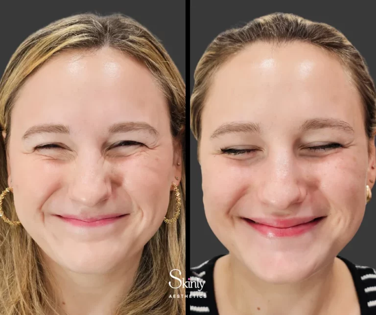 Before and after Botox treatment for crow’s feet wrinkles around the eyes.