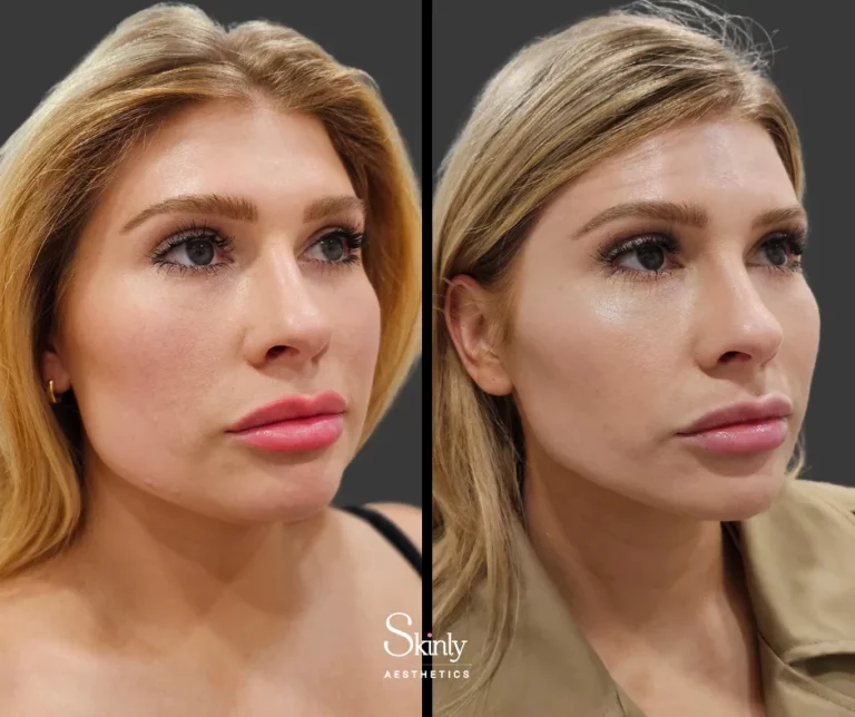 Before and after masseter Botox injections, showing softened jawline
