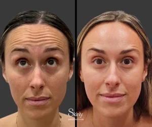 Before and after Botox for horizontal forehead lines, showing smoother skin