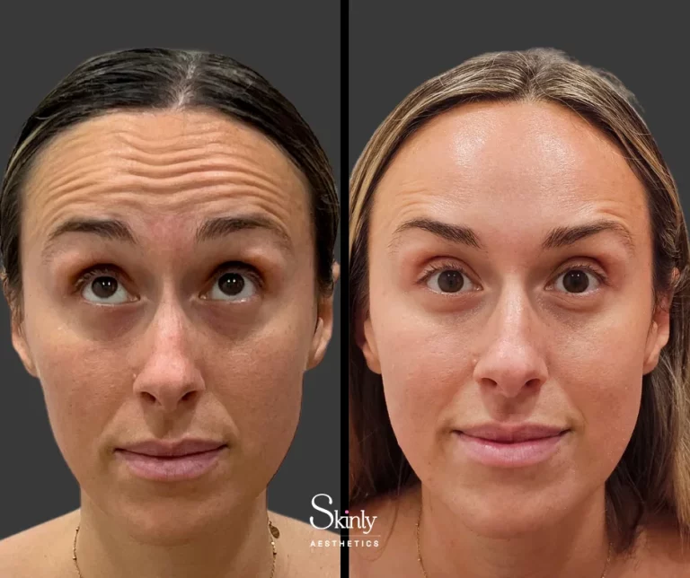 Before and after Botox for horizontal forehead lines, showing smoother skin