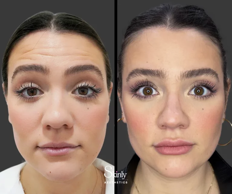 Before and after Botox for forehead wrinkles.
