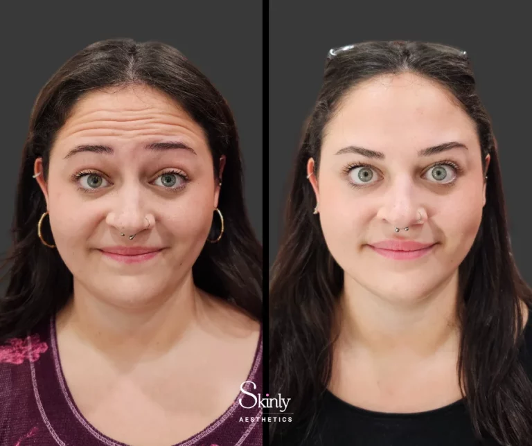 Before and after Botox for softening horizontal forehead lines in NYC.