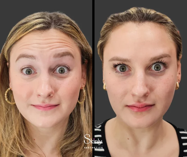 Before and after Botox for horizontal forehead wrinkles, showing a smooth forehead.
