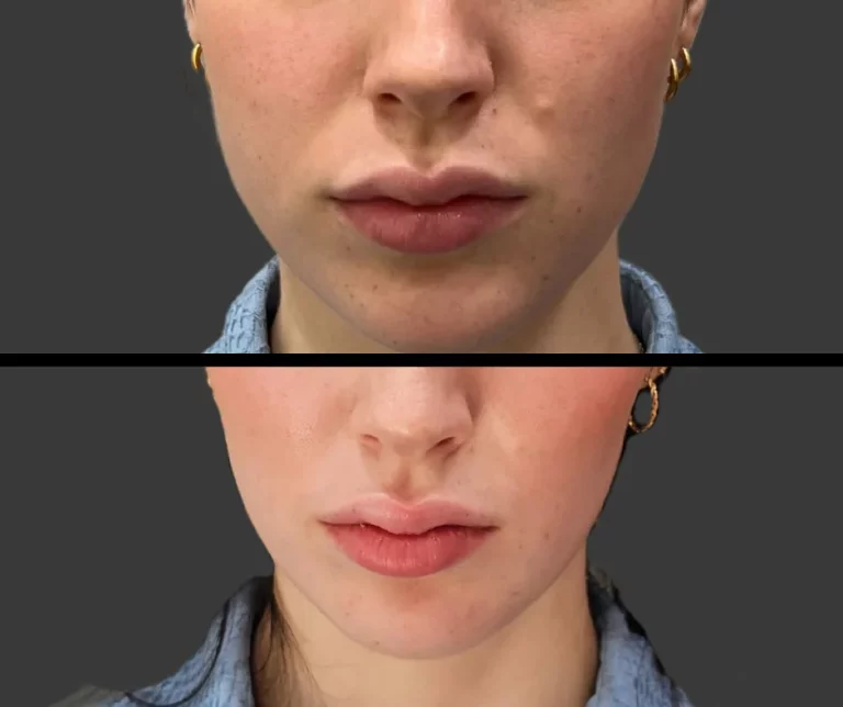 Before and after Botox lip flip for enhanced upper lip curl and subtle volume.