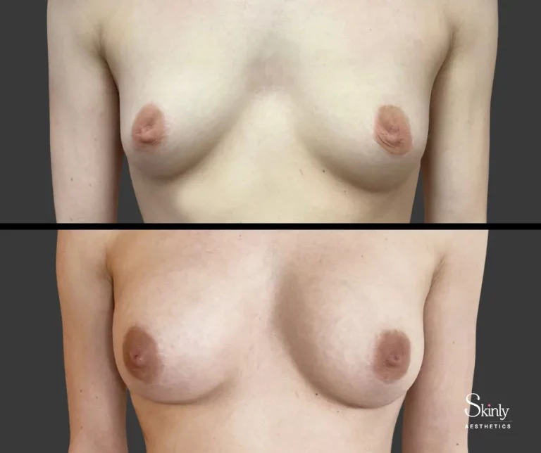 Before and after breast lift with filler, showing more symmetrical shape.