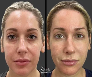 Before and after cheek augmentation with filler, showing enhanced structure.