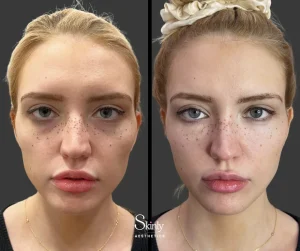 Before and after cheek filler for enhanced cheek contour.