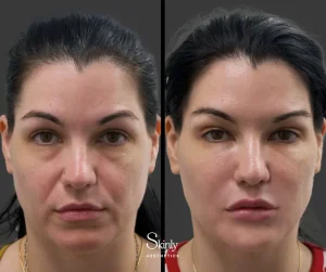 Before and after cheek filler for volume enhancement.