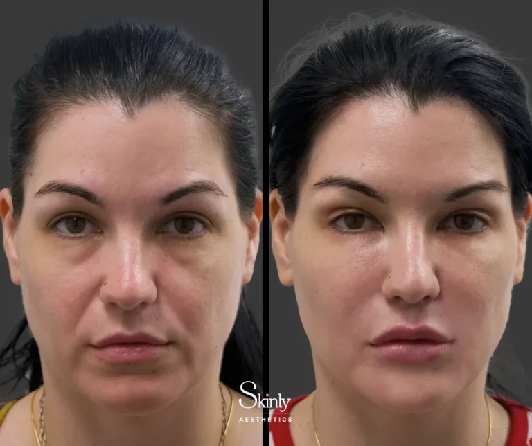 Before and after cheek filler for volume enhancement.