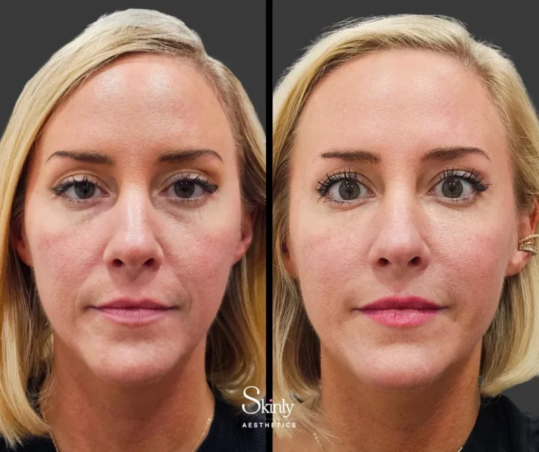 Before and after cheek filler showing defined cheekbones.