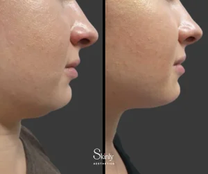 Before and after chin fat removal with Kybella, showing defined jawline.