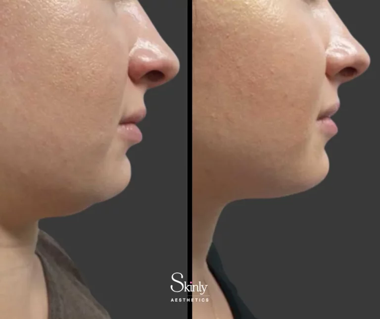 Before and after chin fat removal with Kybella, showing defined jawline.