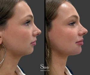 Before and after chin filler on a female patient showing improved definition.