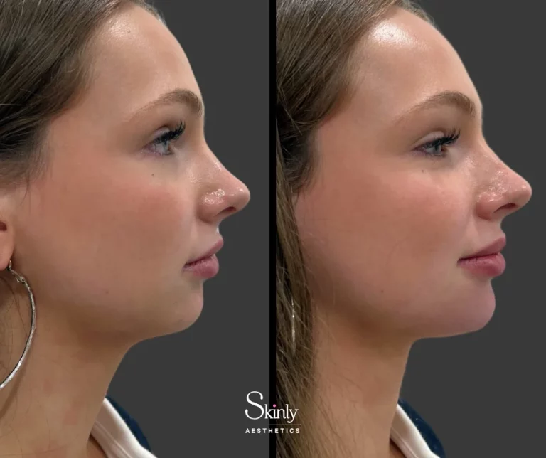 Before and after chin filler on a female patient showing improved definition.