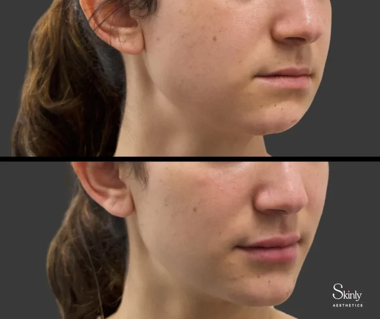 Before and after chin filler showing enhanced chin projection.