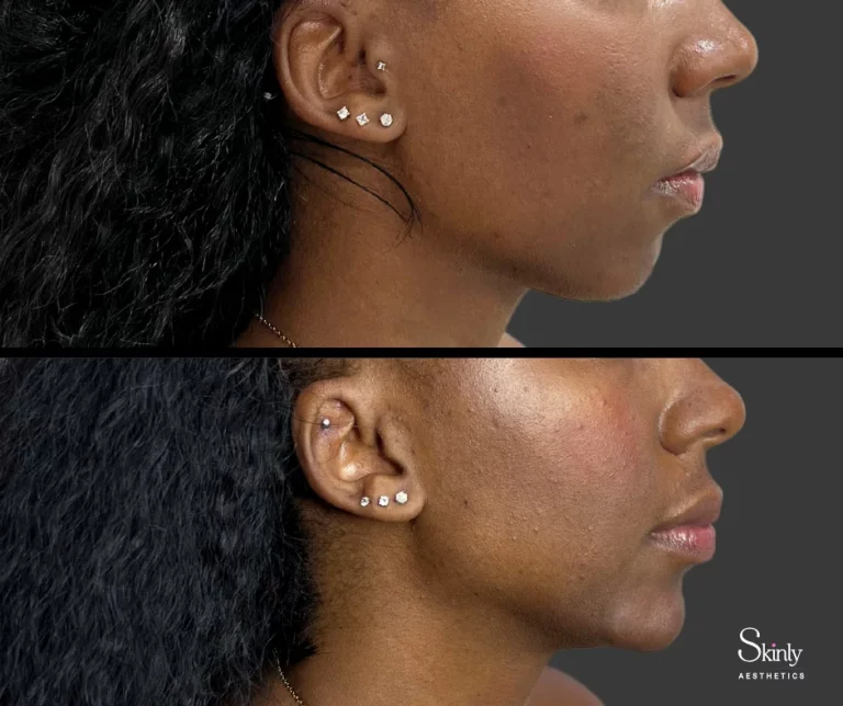 Before and after chin filler for enhanced chin shape.