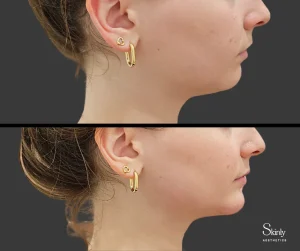 Female patient before and after chin filler, showing enhanced facial balance.