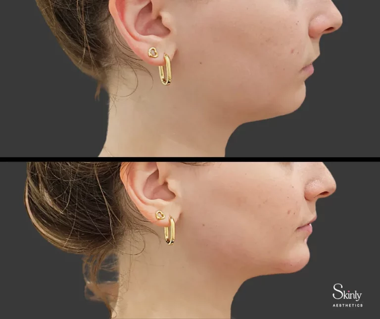 Female patient before and after chin filler, showing enhanced facial balance.