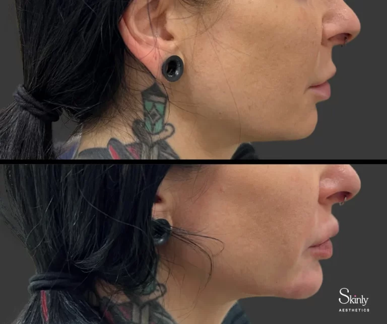 Before and after chin filler showing structured lower face.